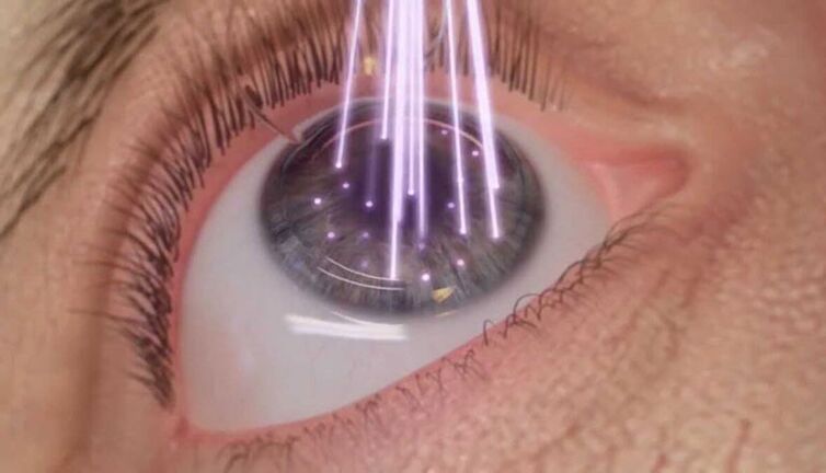 laser eye surgery