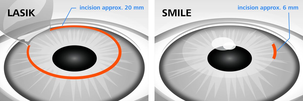 Comparison of laser vision correction LASIK and SMILE methods